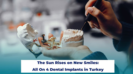 The Sun Rises on New Smiles: All On 4 Dental Implants in Turkey