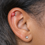Early Signs of Ear Keloids